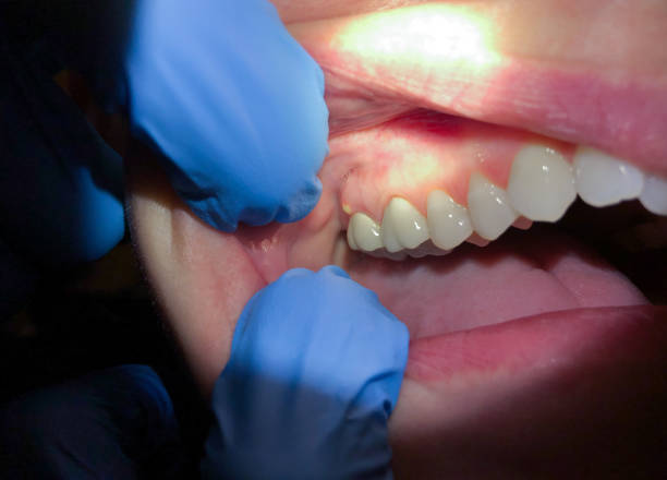 Best Emergency Treatment for Dental Infections or Abscesses in Winsted, CT